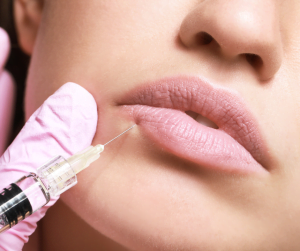 The Art and Science of Lip Augmentation: Dermal Fillers and Techniques